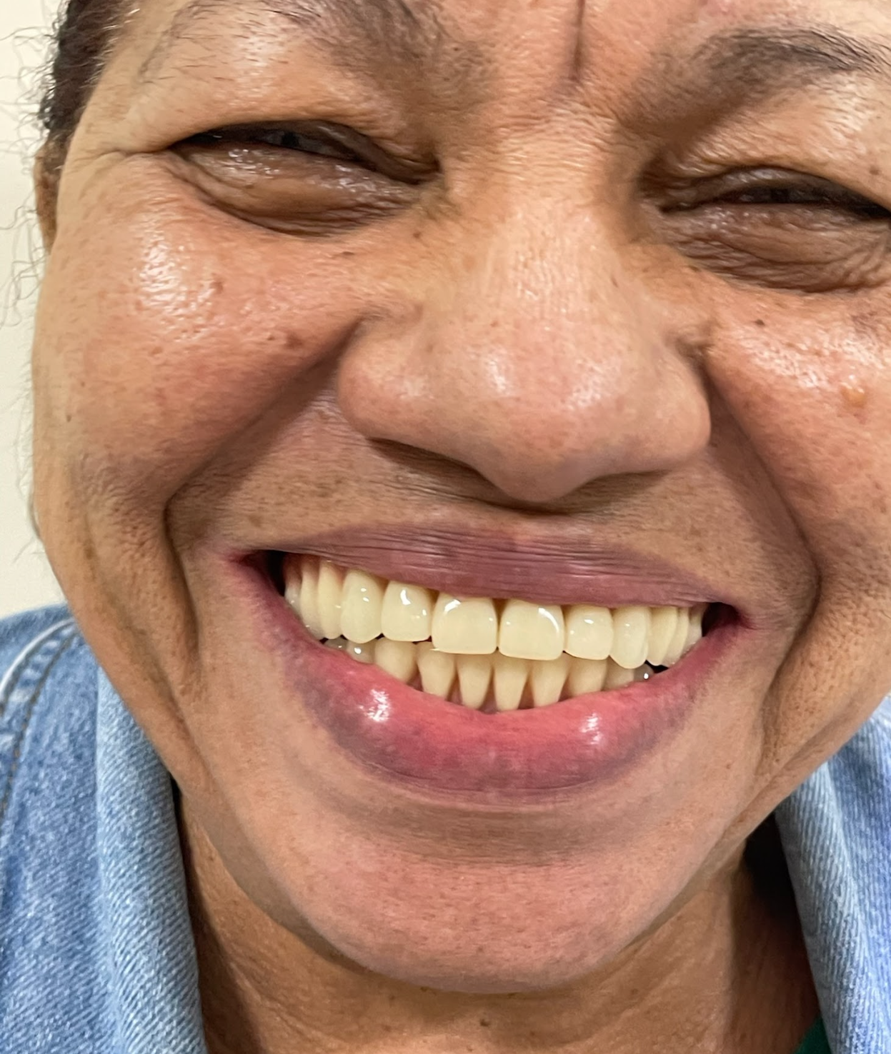 Sorriso com alguns dentes repostos